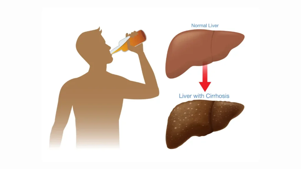 Liver Failure Due to Alcohol