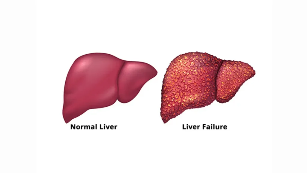 Acute Liver Failure